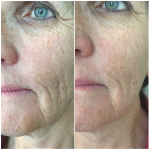 Micro Channeling Facial- Sale $179 Photo