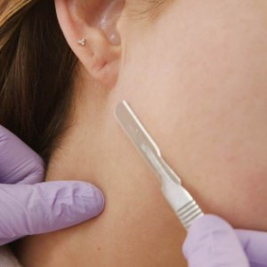 Dermaplaning Photo